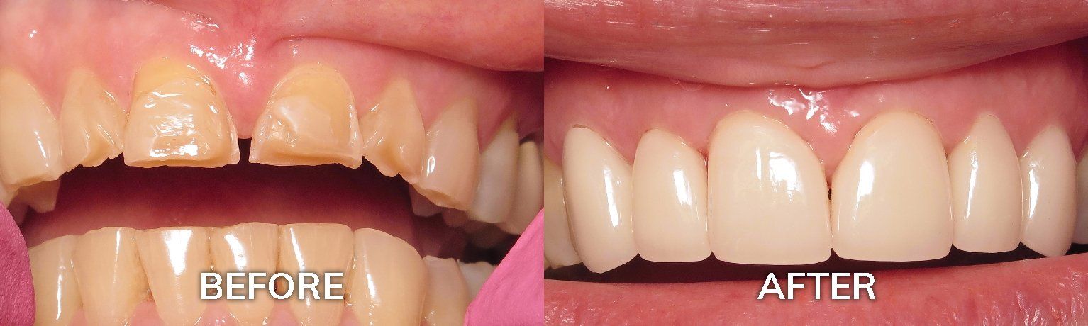 Porcelain Crowns Before and After | Dental Crowns Tuscaloosa AL 35401