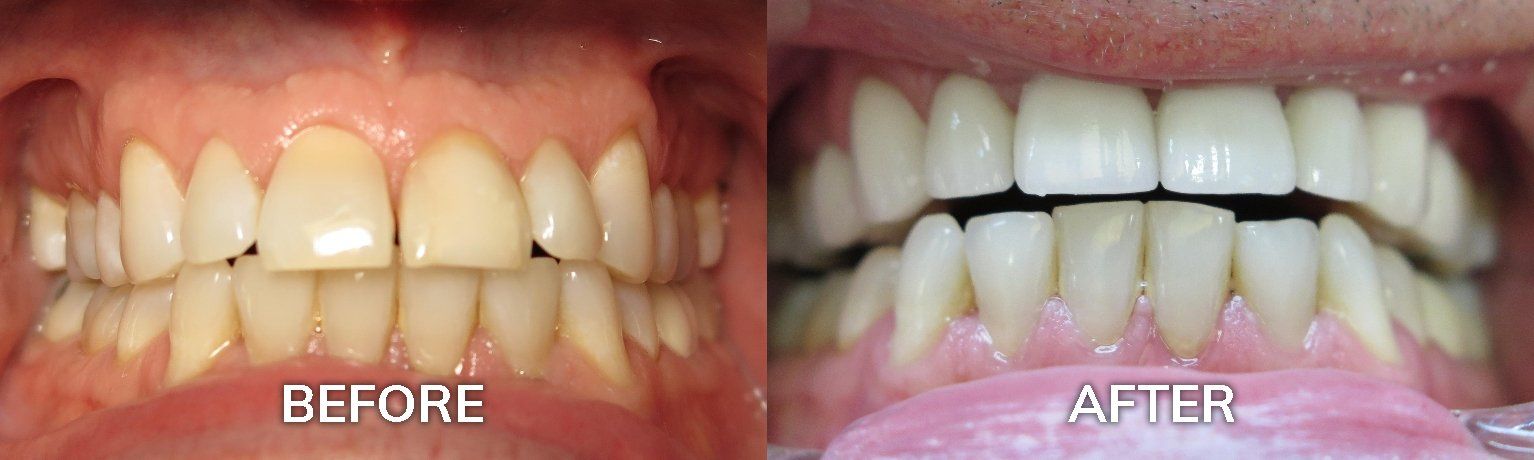 Veneers | Before and After Photo | Family Dentist Tuscaloosa AL 35401