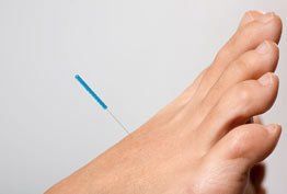 Acupuncture