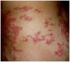 Cutaneous Larva Migrans – Bradenton, FL – Molter Termite and Pest Control