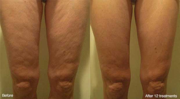 A before and after photo of a person 's legs