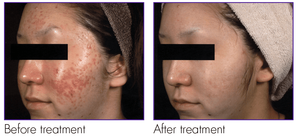 A before and after photo of a woman 's face with acne.