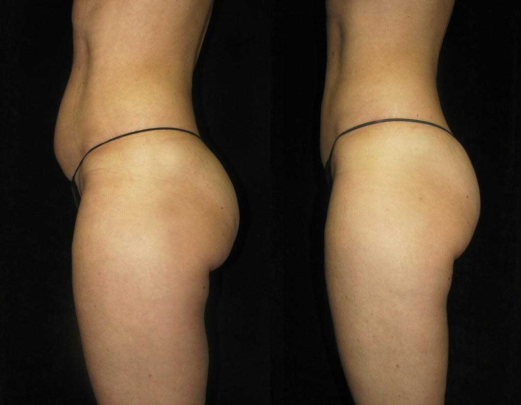Weight Loss Program & FDA  ﻿Approved Contour Light Treatments