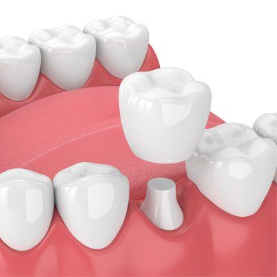 Chip Repair — Crowns Installation in Modesto, CA Chip Repair — Crowns Installation in Modesto, CA