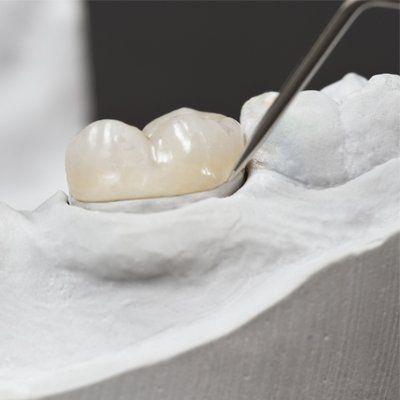 Tooth Bonding — Crowns in Modesto, CA Tooth Bonding — Crowns in Modesto, CA