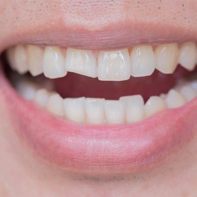 Cosmetic Dentistry — Damaged Teeth in Modesto, CA Cosmetic Dentistry — Damaged Teeth in Modesto, CA