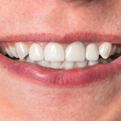 Tooth Bonding & Chip Repair — Perfectly Repaired Teeth in Modesto, CA Tooth Bonding & Chip Repair — Perfectly Repaired Teeth in Modesto, CA