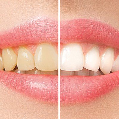 Teeth Bleaching — Before and After in Modesto, CA Teeth Bleaching — Before and After in Modesto, CA