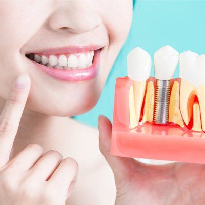 Dental Implants — Complete White Teeth in Modesto, CA Dental Implants — Complete White Teeth in Modesto, CA