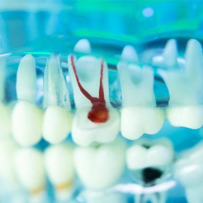 Tooth Extractions — Teeth in Modesto, CA