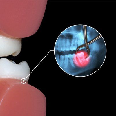 Extraction Options — Tooth Extraction Demo in Modesto, CA