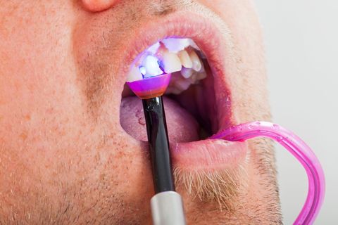 Cosmetic Dentistry — Damaged Teeth in Modesto, CA Cosmetic Dentistry — Damaged Teeth in Modesto, CA
