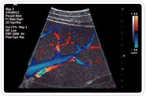 eco color doppler