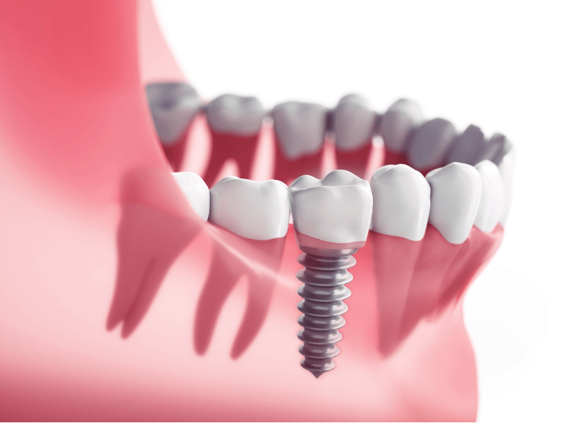 Implantate oder Vollprothese? Wie ich eine richtige Entscheidung treffen kann