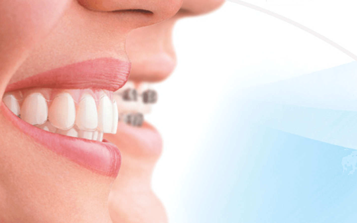 invisalign