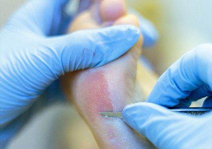 removal of corns