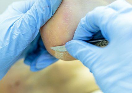 callus being removed