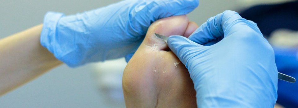 hard skin removal