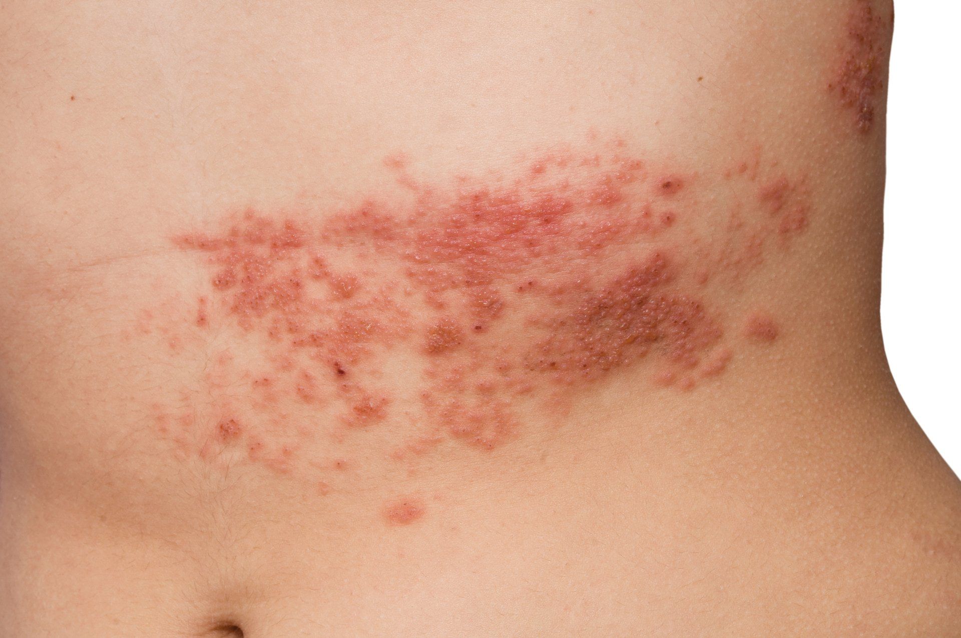 COMPLETE GUIDE TO SHINGLES
