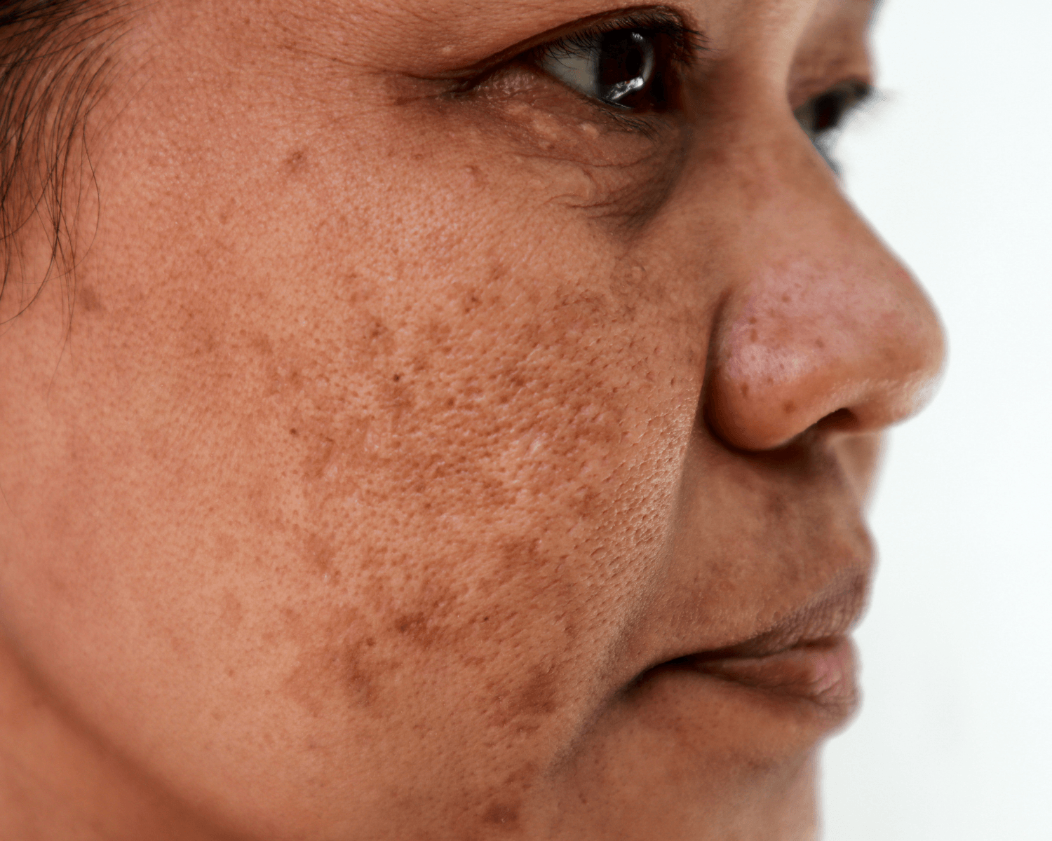 hyperpigmentation illustration