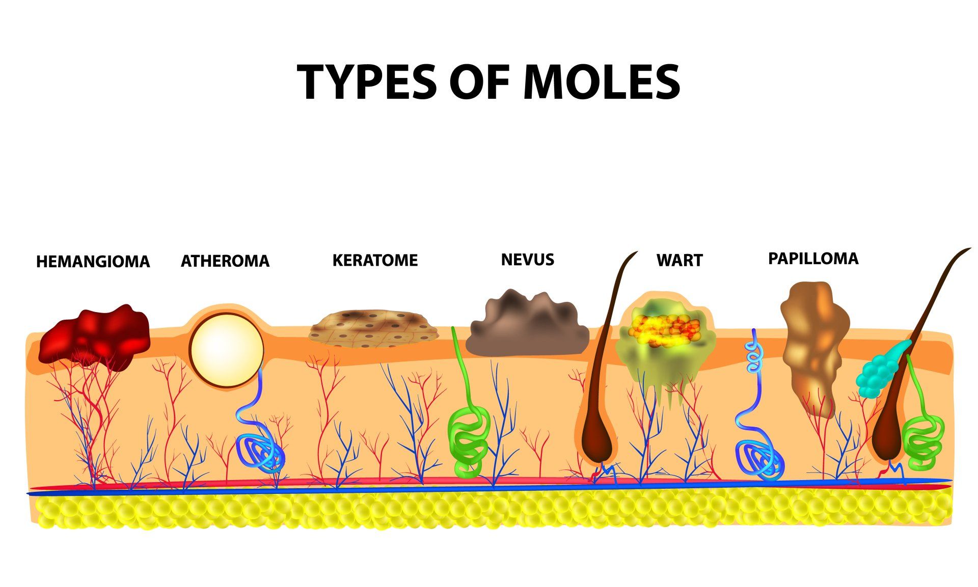Wart Anatomy