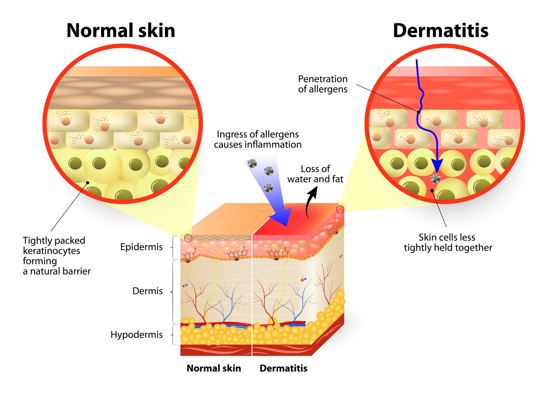 Normal Skin vs. Dermatitis
