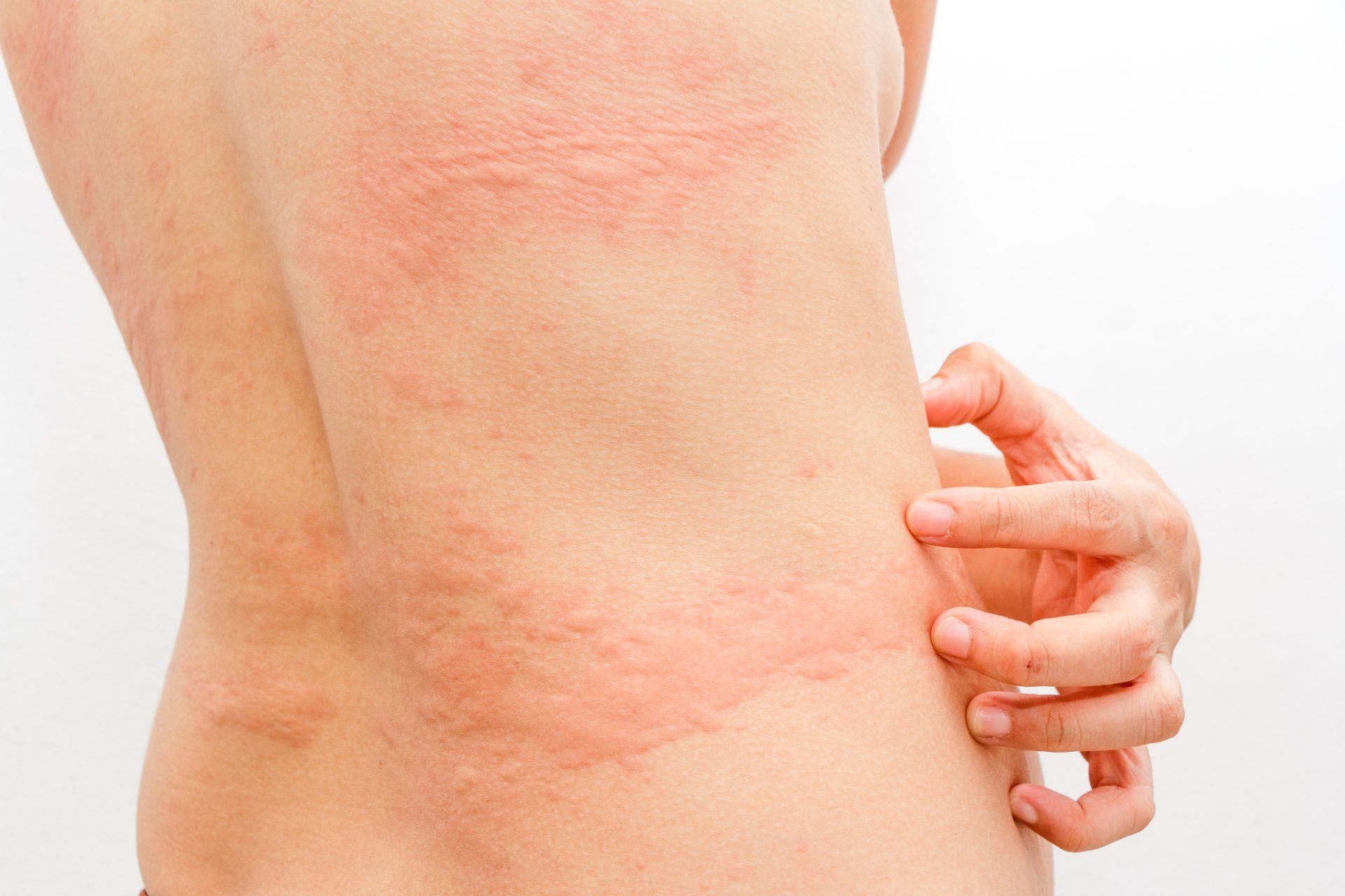 What do hives look like