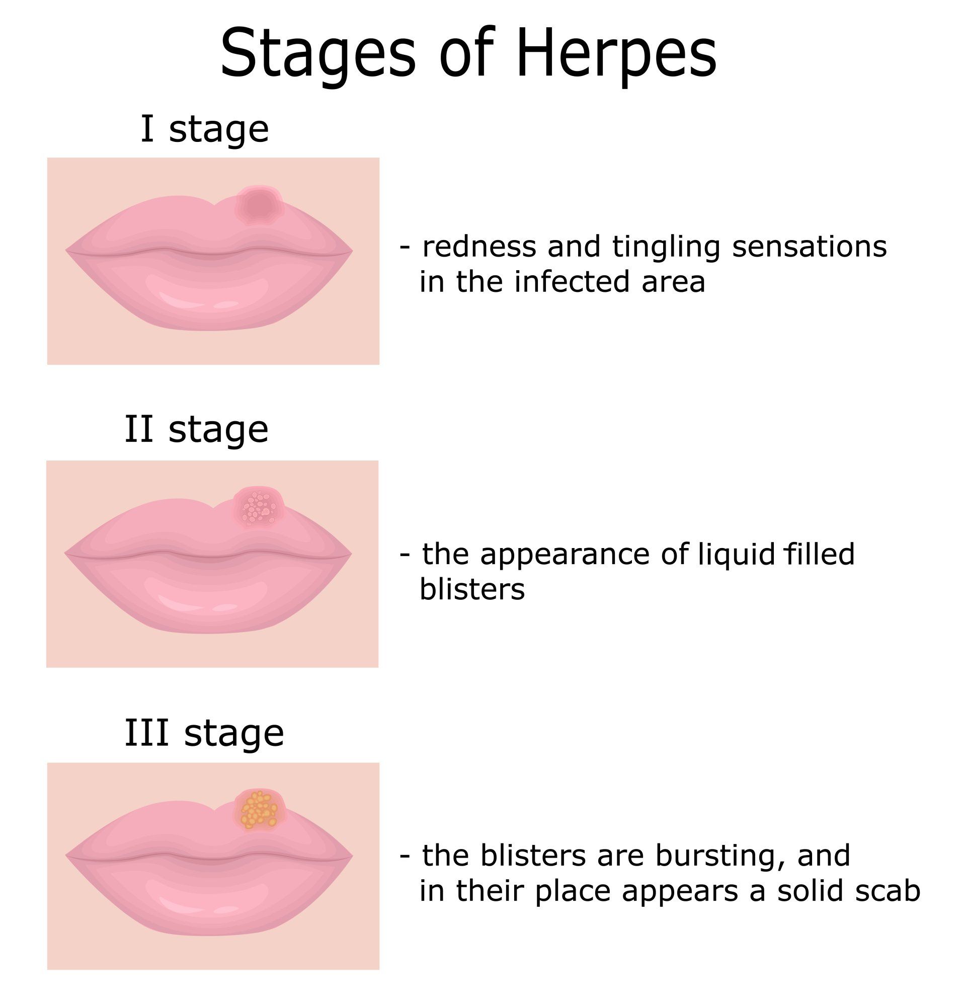 Stages of Herpes