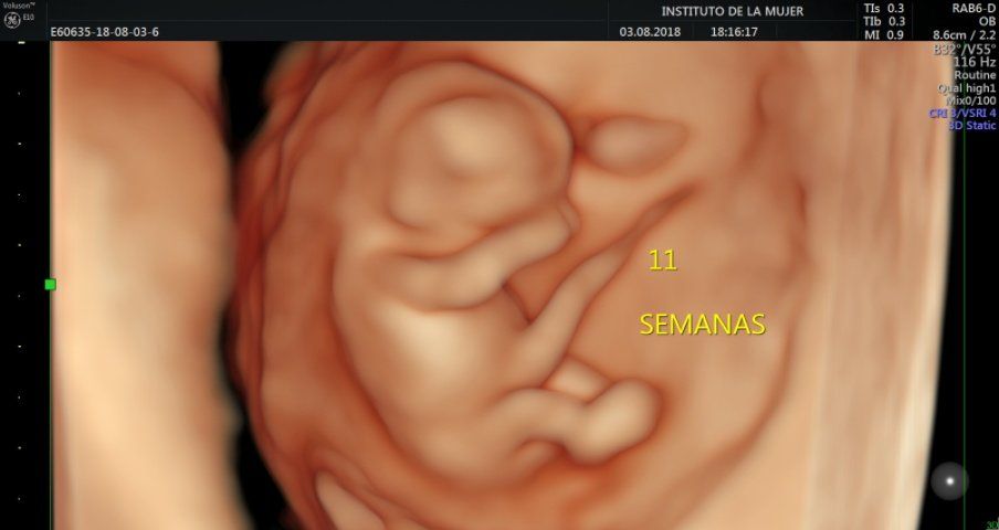 tamizaje prenatal