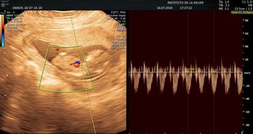 Tamizaje prenatal