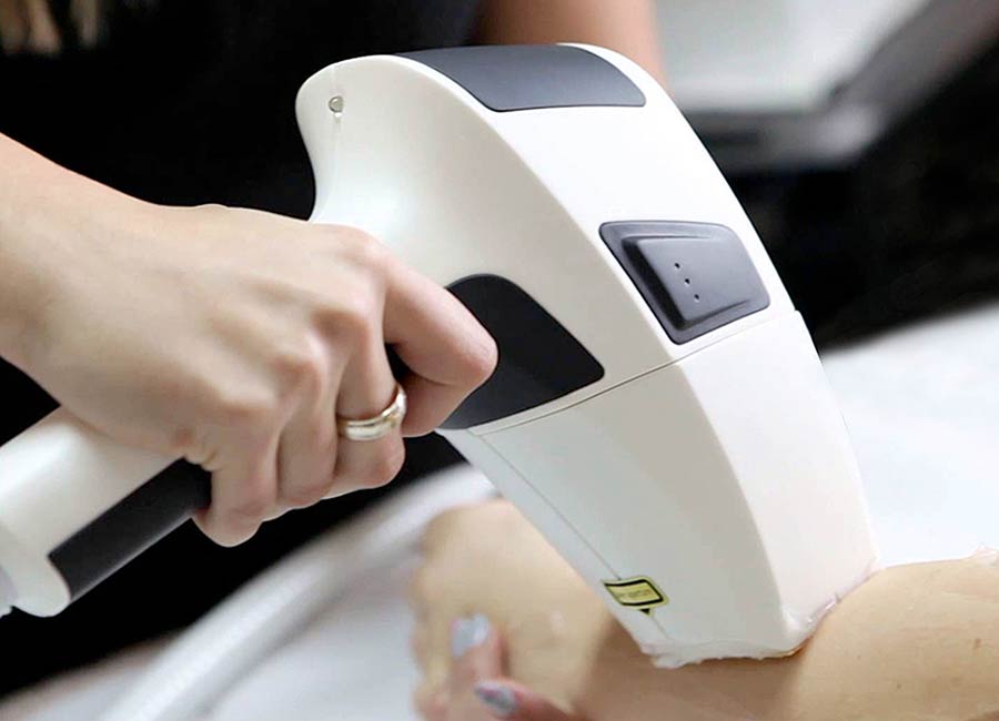 depilazione laser delle ascelle