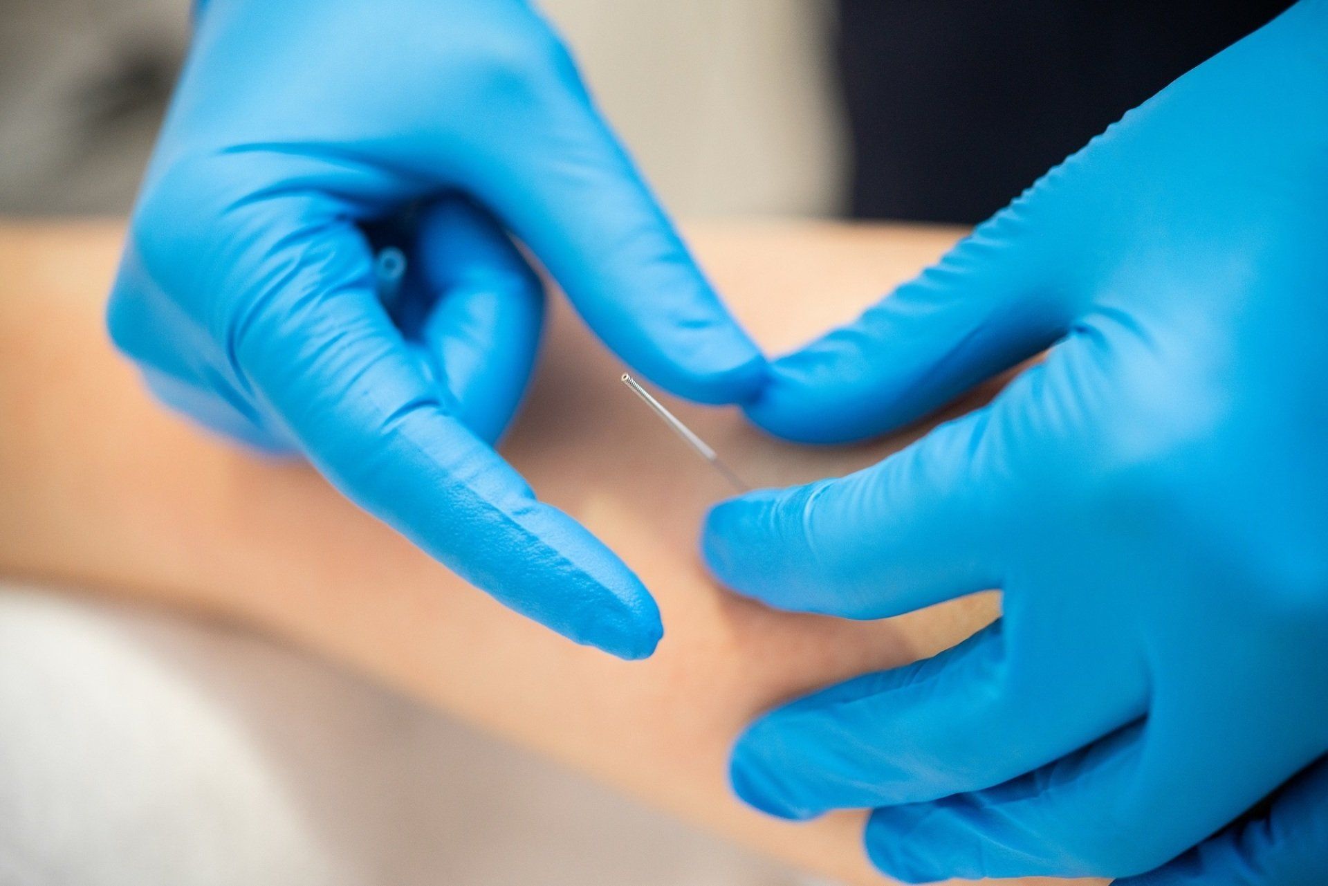 Dry Needling Therapy