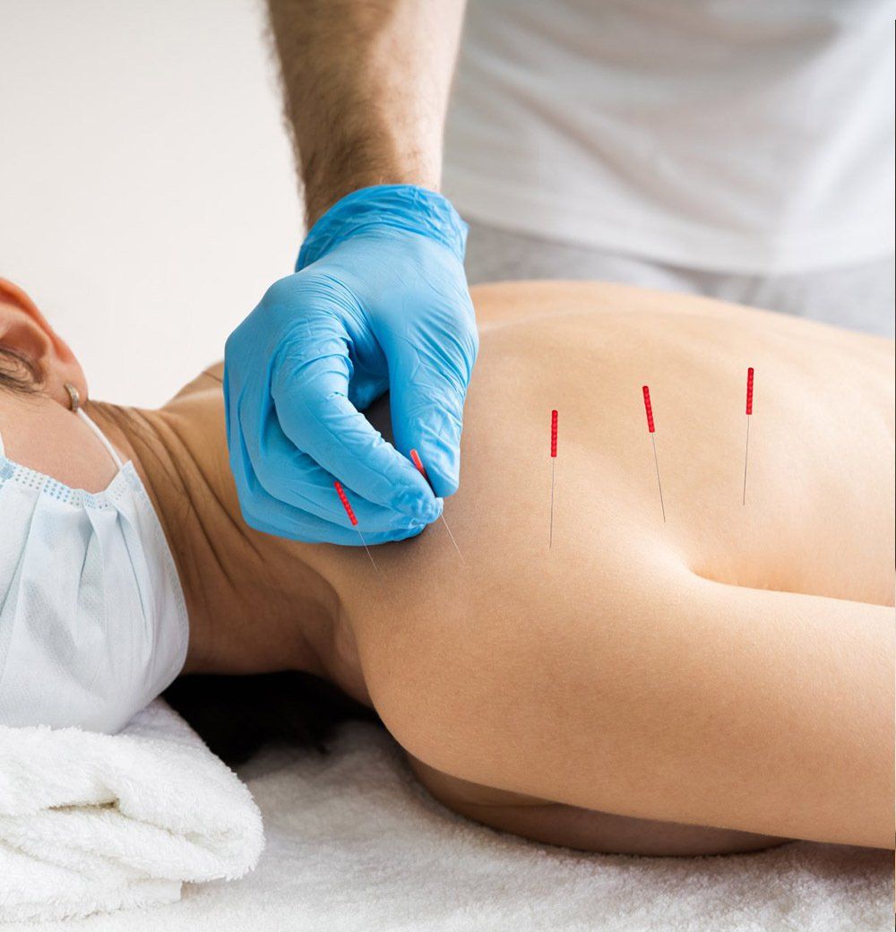 Acupuncture Skin Treatment — Dry Needling in Port Stephens, NSW