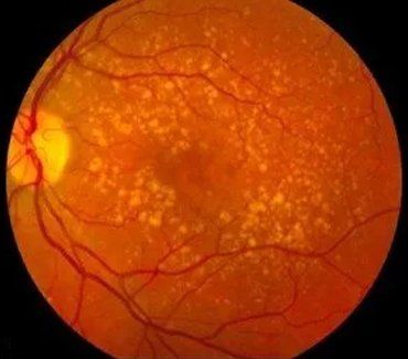 Dry MD