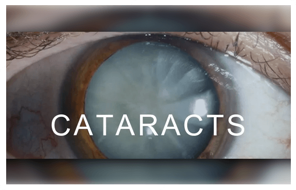 cataracts