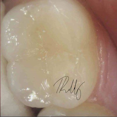 after image patient number one