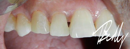 after image patient number six