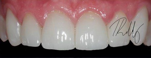 after image patient number three