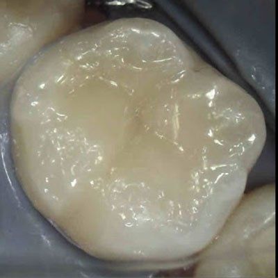 after image patient number two