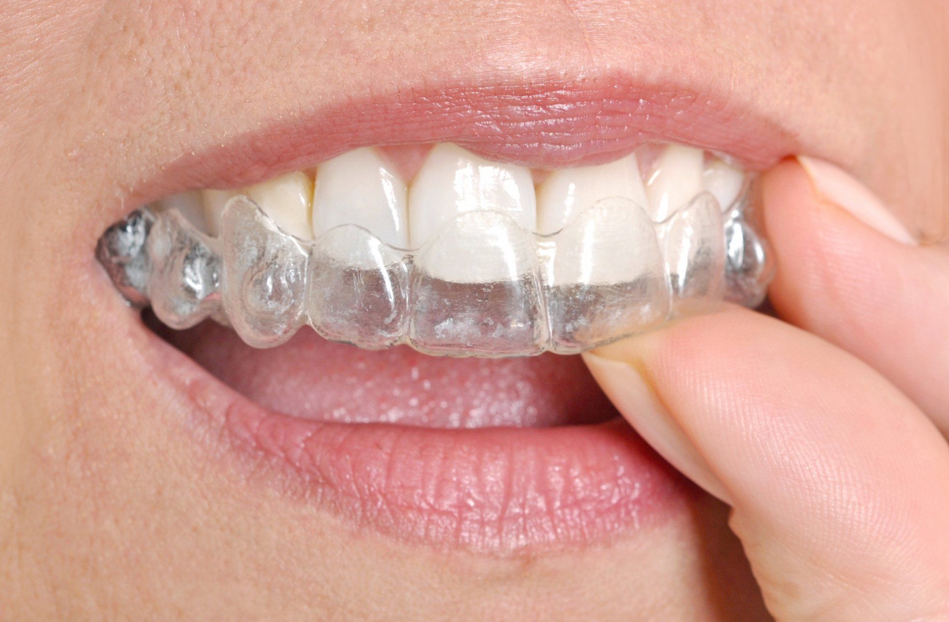 Person's mouth with clear aligner in place, fingers holding the aligner, white teeth visible.