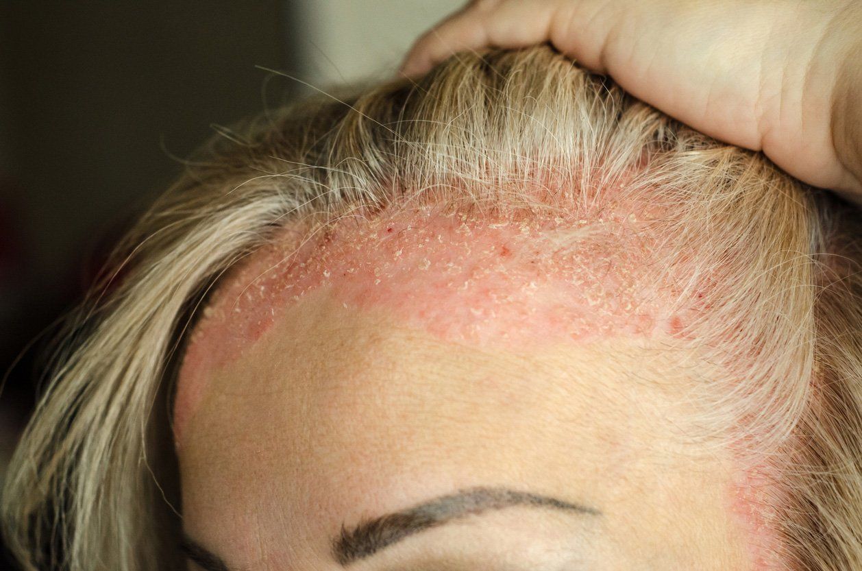 dry red scalp