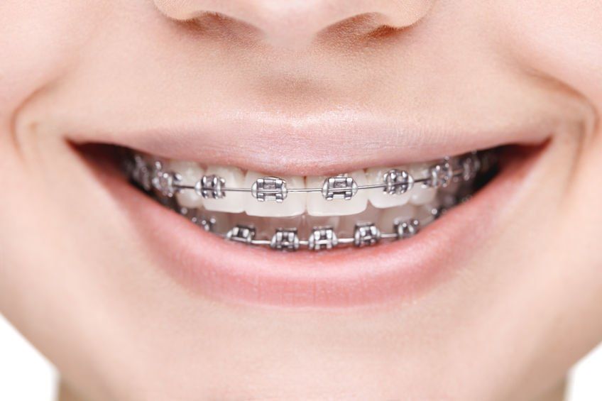 child with braces on teeth