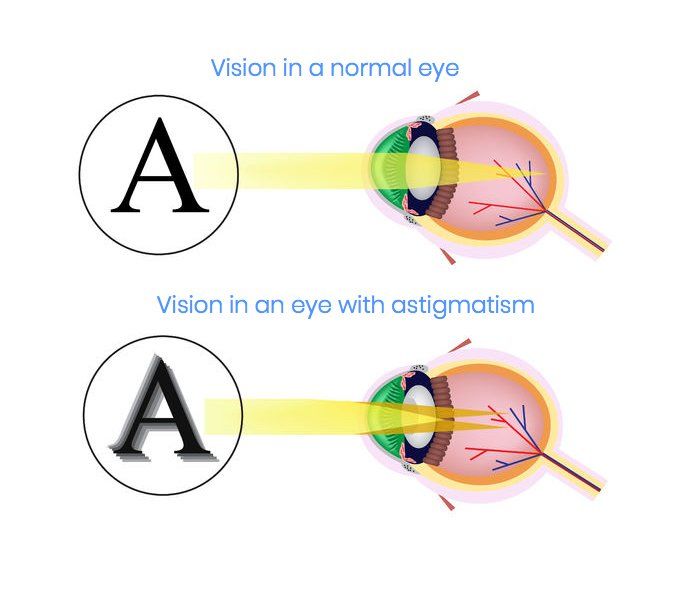 A diagram of vision in a normal eye and vision in an eye with astigmatism
