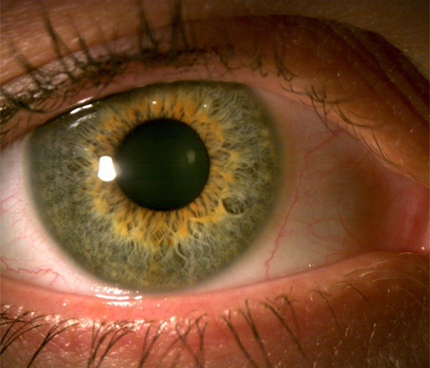 bloodshot eye