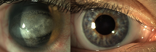 prosthetic and cosmetic contact lenses are available at Focal Pointe Eye Care
