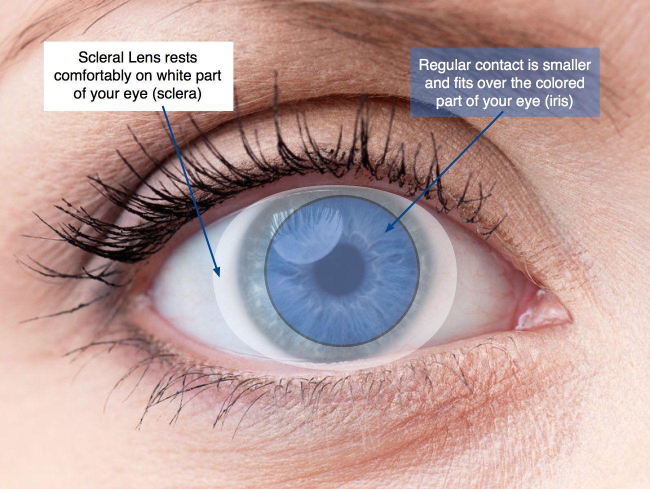 scleral lenses