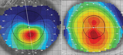 corneal