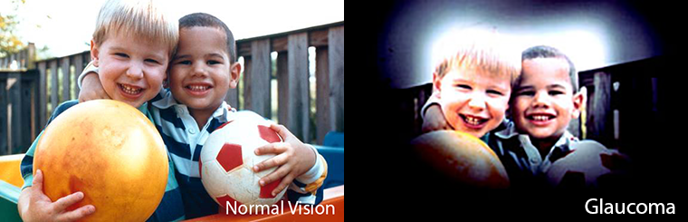 A picture showing normal vision vs vision with glaucoma