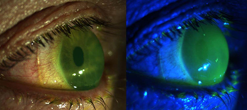 corneal