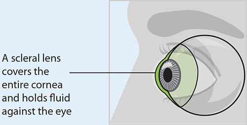 A scleral lens covers the entire cornea and holds fluid against the eye.